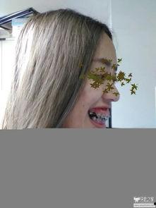 箍牙图片,箍牙前后对比,见证牙齿蜕变之旅