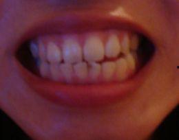 箍牙图片,箍牙前后对比,见证牙齿蜕变之旅